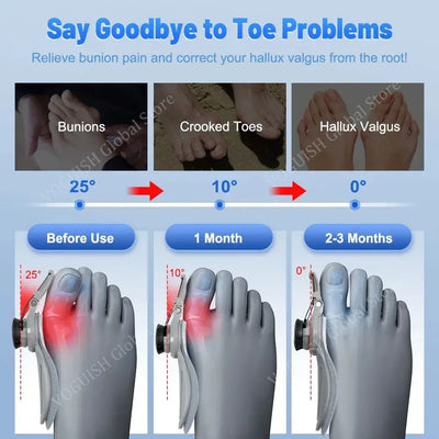 Bunion Correcter